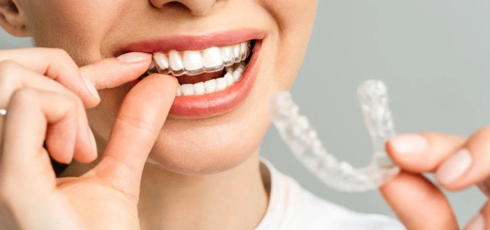 Orthodontiste adulte La Roche-sur-Foron 74800