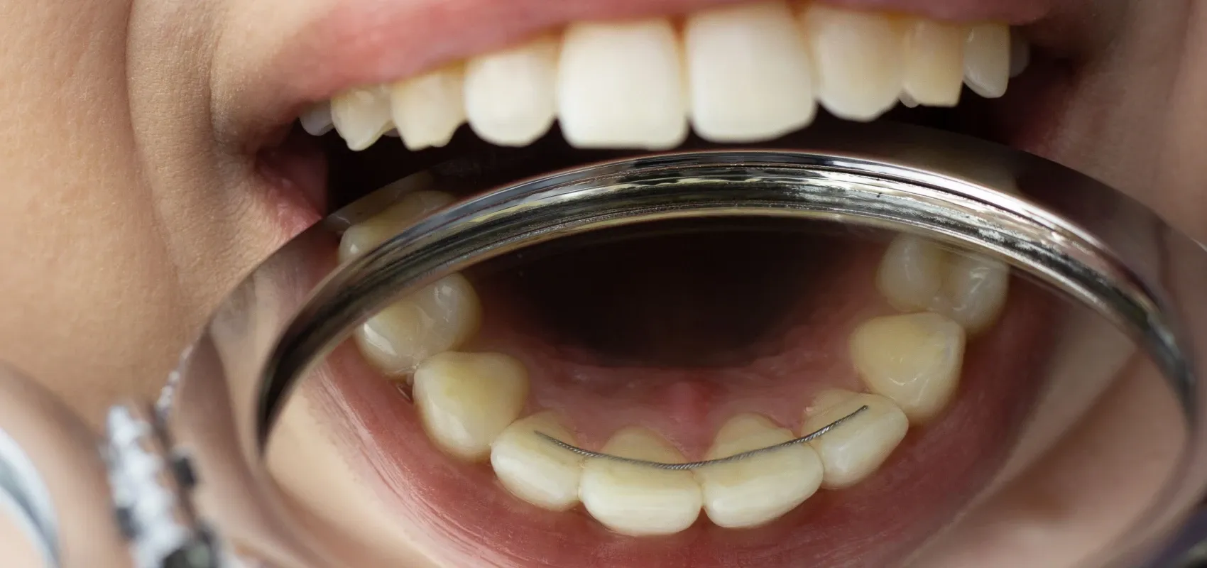 Contention orthodontiste la roche sur foron estelle baillet